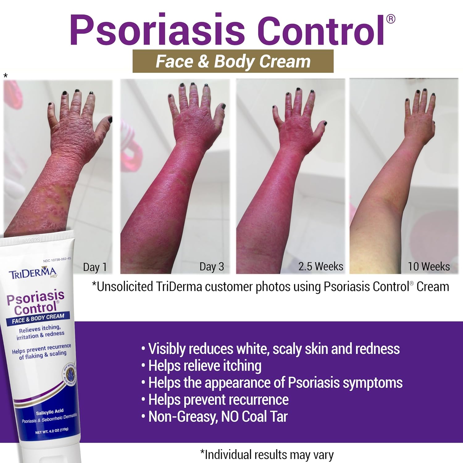 TriDerma Psoriasis Control Face & Body Cream - Maximum Strength 3% Salicylic Acid, AP4 Aloe Vera Gel, Urea Cream - Extra Moisturizing Treatment, No Cortisone or Coal Tar - FSA Eligible - 4.2 oz, 4Pack - Image 2