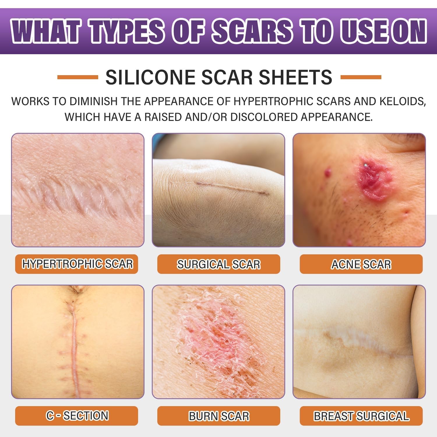 Silicone Scar Sheets, Medical Grade Silicone Scar Tape for Old & New Scars | Scar Tape for Surgical, Hypertrophic, Keloid, C-Section, Burn Scars, Reusable Professional Scars Removal (1.6"X59" Roll-1.5M) - Image 2