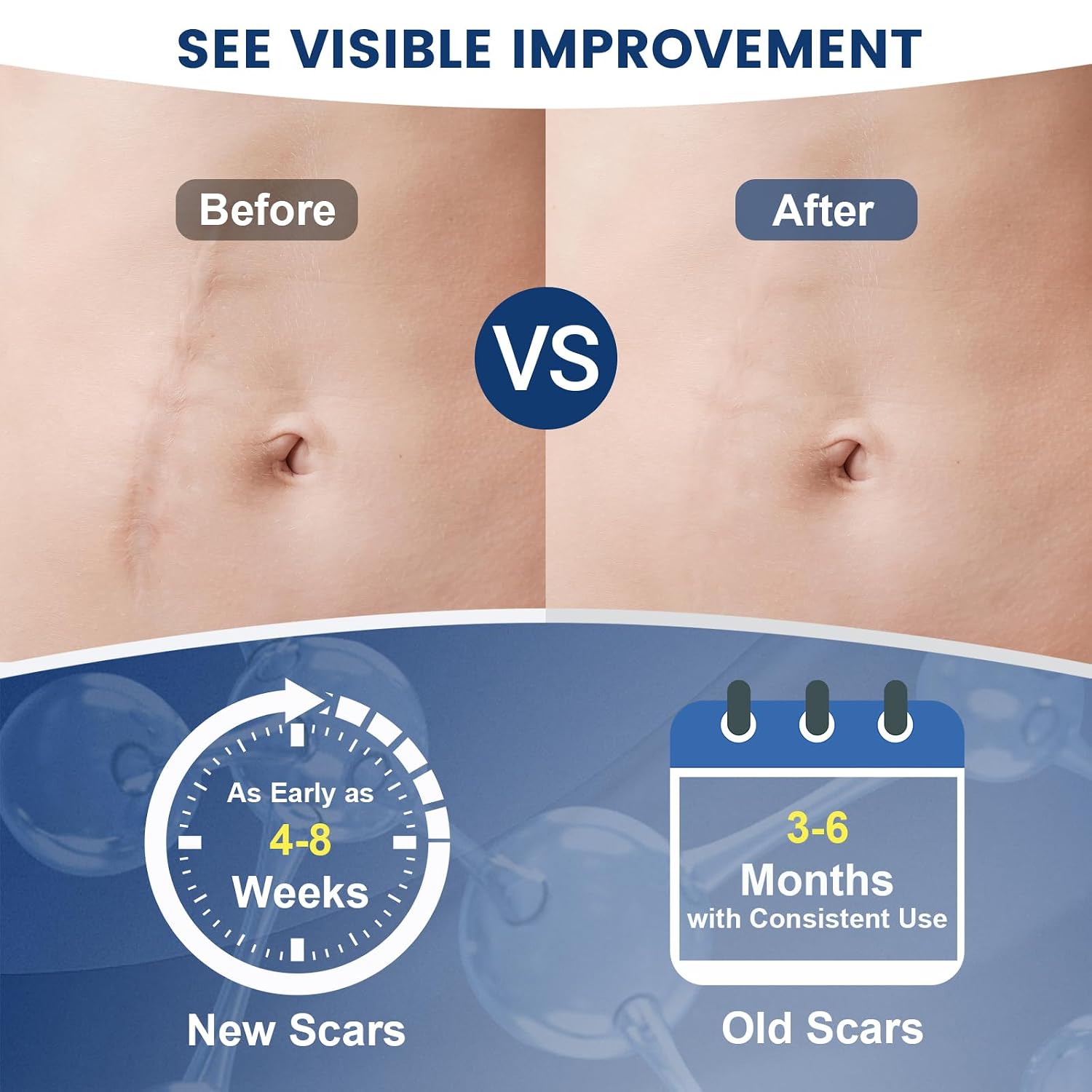 Rvlaim 100% Advanced Silicone Scar Gel for Old & New Scars,1.7oz/50ml | Hypoallergenic and Fast-absorbing Effective for Surgical, Burns, Acne, C-Section, Keloid Scars and Stretch Marks - Image 4
