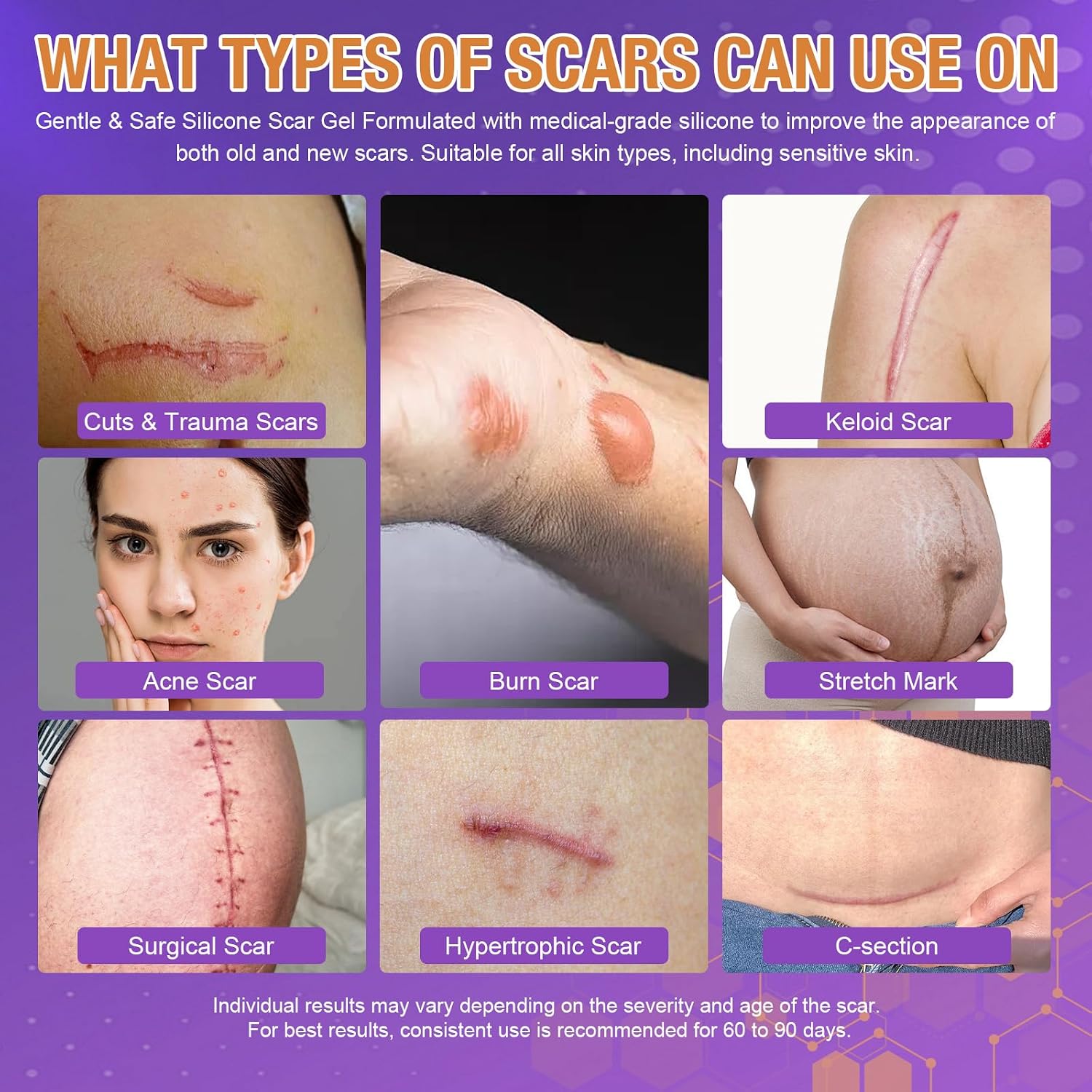Advanced Scar Gel – Silicone Scar Gel for Keloid Bump Removal, Post-Surgery Scars, Acne Scars, Burn Marks & Stretch Marks – Scar Treatment for Old & New Scars – 1.2oz / 35g - Image 3