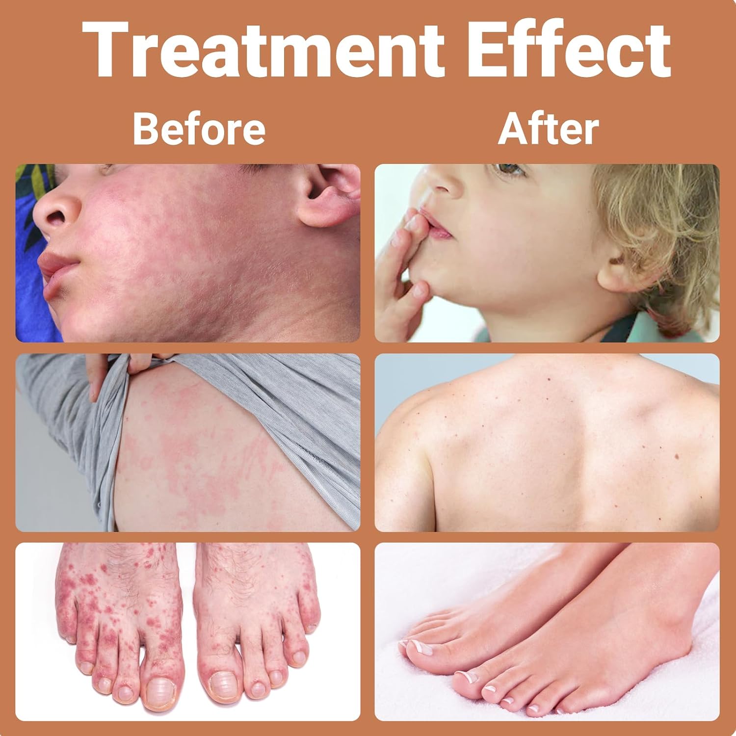 Urticaria Cream for Hives Relief - Fast Acting Anti Itch Treatment with All Natural Herbal Formula for Skin Allergic Rashes, Redness, Swelling 3.53 oz - Image 4