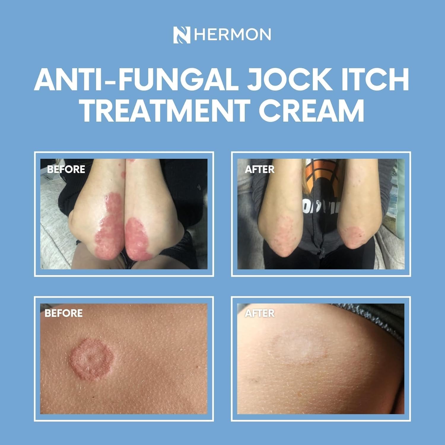 Hermon Jock Itch Antifungal Cream, Ringworm Treatment for Humans, Athlete's Foot Treatment, Ringworm Cream for Humans, Foot & Body Balm, Provides Soothing Relief-2 Pack - Image 6