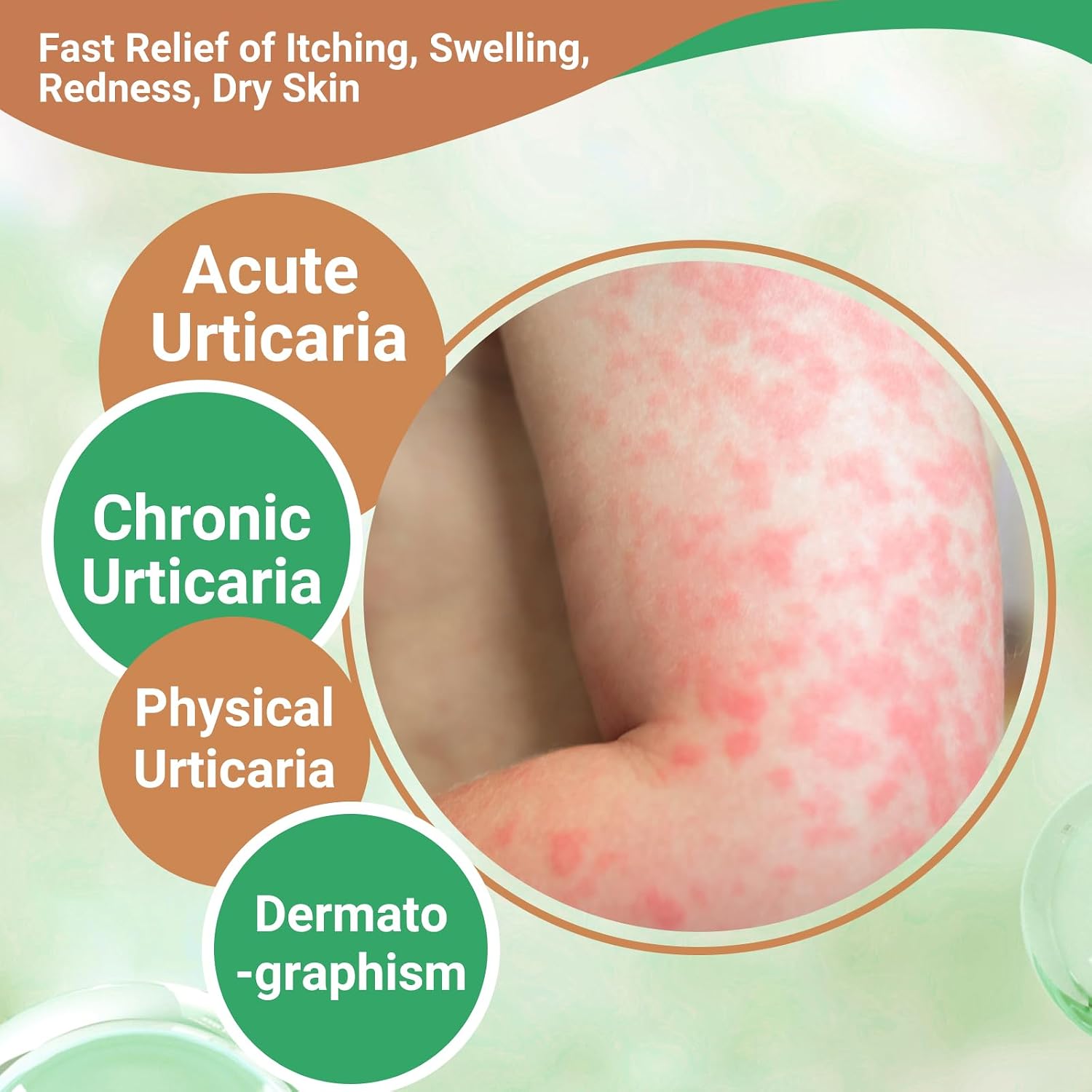 Urticaria Cream for Hives Relief - Fast Acting Anti Itch Treatment with All Natural Herbal Formula for Skin Allergic Rashes, Redness, Swelling 3.53 oz - Image 2